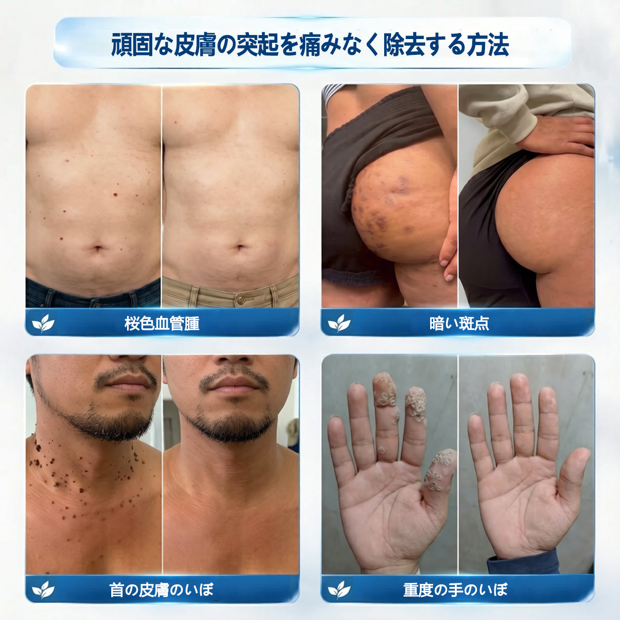 🛡️公式ストア🎉7日間スポット＆シミ除去ケア （ゼロ痛み・ゼロダメージ ローラーボール）🛡️🛡️