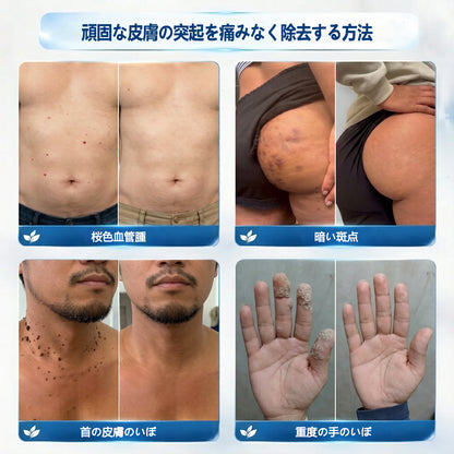 🛡️公式ストア🎉7日間スポット＆シミ除去ケア （ゼロ痛み・ゼロダメージ ローラーボール）🛡️🛡️