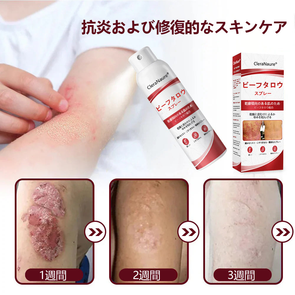 🥇CleraNaure® ビーフタロウスプレー — かゆみ・皮膚の剥がれを抑える乾癬用スキンケアスプレー🥇